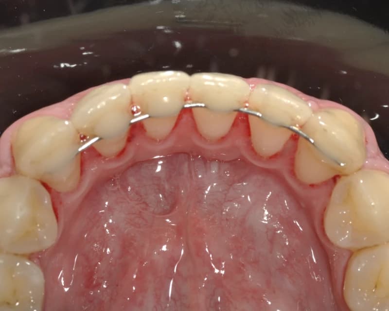 Resultado de limpeza dental na Fabrin Odontologia em Ijuí