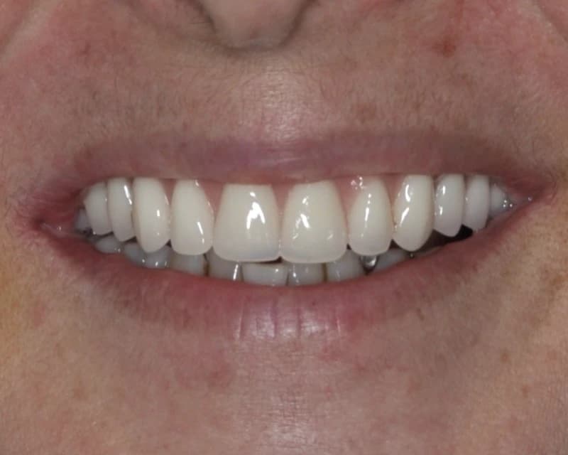Resultado de protocolo sobre implante dentário em Ijuí