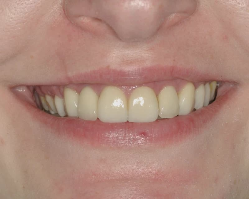 Resultado de reabilitação cerâmica com prótese dentária em Ijuí